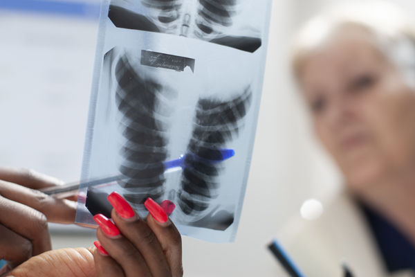 A close-up view of a medical professional holding a chest X-ray image showing lung structures, with a pen pointing to a specific area on the film. The X-ray is being examined in a clinical setting, suggesting a discussion about respiratory health or asbestos-related lung conditions.
