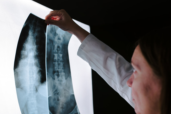 A doctor examines spinal X‑ray images on a light board.